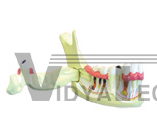 The model of right inferior buccal teeth resolve tissue